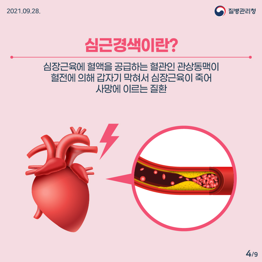 심근경색이란? 심장근육에 혈액을 공급하는 혈관인 관상동맥이 혈전에 의해 갑자기 막혀서 심장근육이 죽어 사망에 이르는 질환